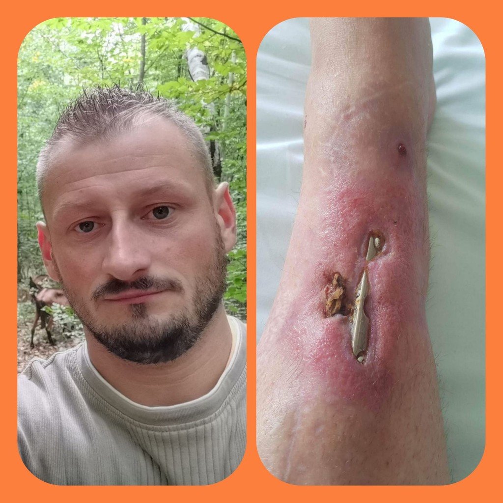 Spasimo nogu 32-godišnjeg Berina
